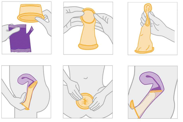 Hình ảnh minh họa cách bước sử dụng bao cao su dành cho nữ